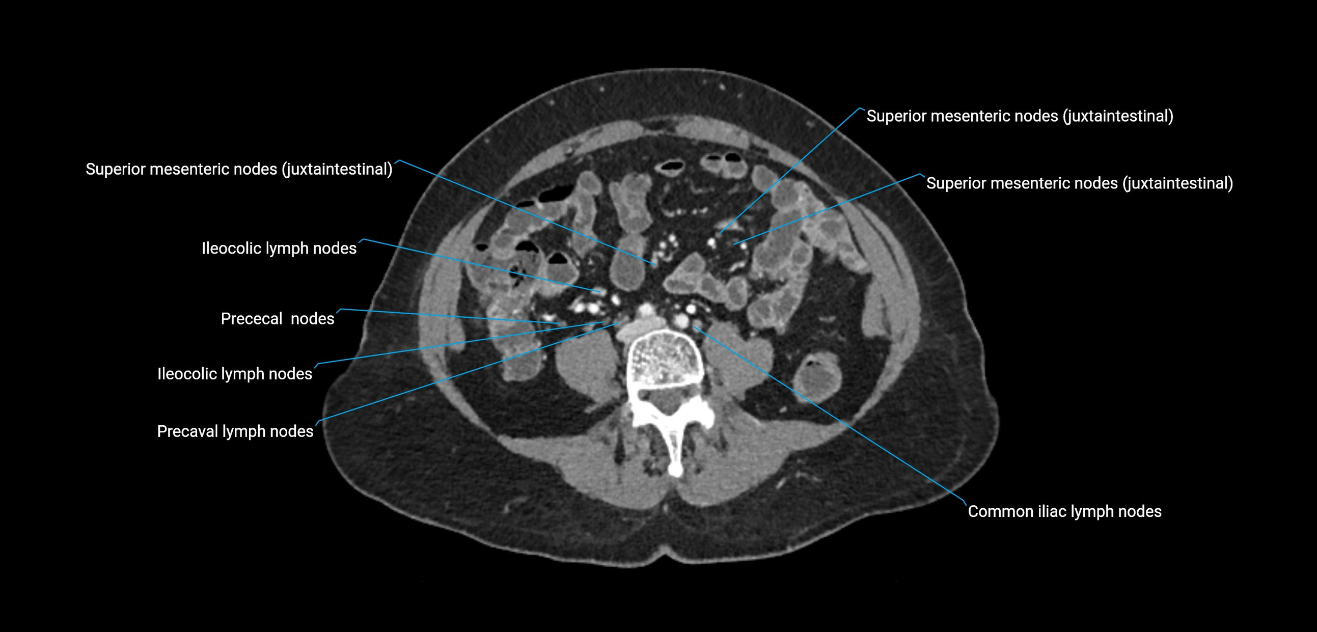CT ct abdominal lymph nodes  axial cross sectional anatomy  enchanced radiology image -img-00002-00273.webp